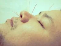 طب سوزنی مثل بوتاکس