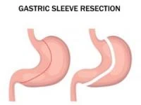 جراحی اسلیو معده