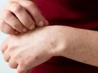 آبله میمونی