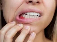 تغذیه لثه