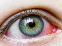 حساسیت چشمی