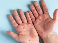 آبله میمونی
