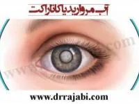 آب مروارید