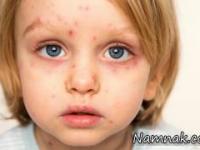 بیماری کاوازاکی