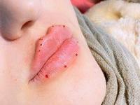 تزریق ژل لب