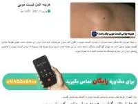 هزینه عمل کیست مویی