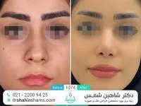 جراحی بینی