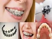 بریس ارتودنسی 
