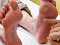 زخم دیابتی