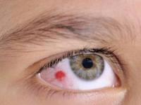 درمان لکه خون در چشم