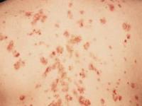 بیماری پمفیگوس