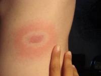 بیماری لایم 