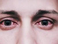 یوئیت چشم 