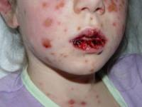 سندرم استیون جانسون