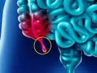فواید آپاندیس
