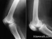 بیماری استخوان مرمری