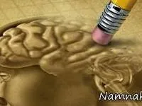 آلزایمر