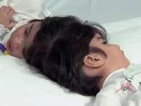 دوقلوی بهم چسبیده