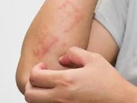 شیوه کنترل اگزما