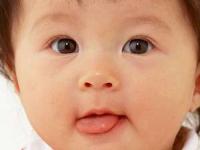 گره زبان نوزاد