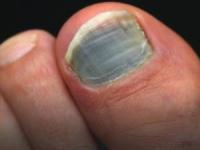 درمان درد کبودی ناخن