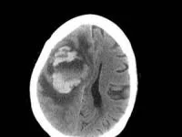 خورده شدن مغز