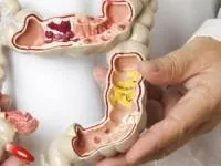 آی بی اس روده