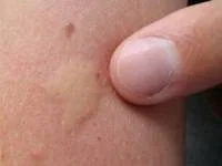 تشخیص نیش حشرات