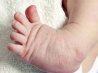 مشکل پای نوزادان