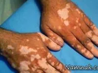 لک و پیس