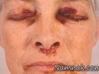 آمیلوئیدوز