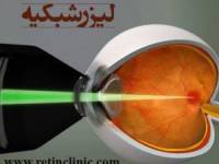 پارگی شبکیه