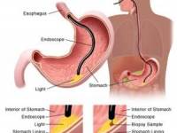 اندوسکوپی معده