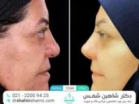 rhinoplasty