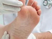 درمان خانگی زخم پای دیابتی
