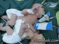 جداسازی دوقلوهای بهم چسبیده