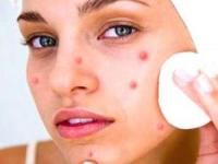 جوش و ریزش مو