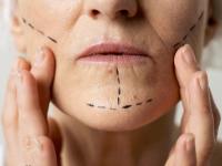 جراحی لیفت صورت