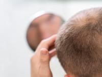 چرا موهای کاشته شده دیر رشد میکند؟