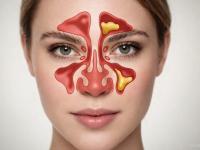 کیست بینی چیست