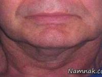 افتادگی پوست گردن