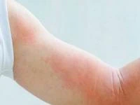 کهیر و آنژیوادم