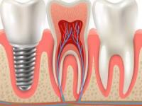 ایمپلنت کاشت دندان