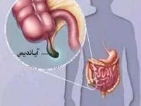 آپاندیس