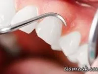 لثه