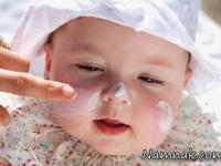 آفتاب سوختگی