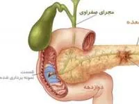 علائم سرطان لوزالمعده 