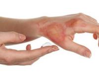 بعد از سوختگی