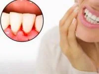 دلیل خونریزی لثه