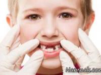 شکستن دندان کودک